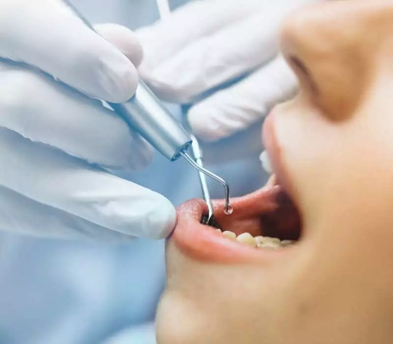 Home 16 Deep Cleaning Periodontics Dentist in Weston Fl Family Cosmetic Dentistry 800 x 700