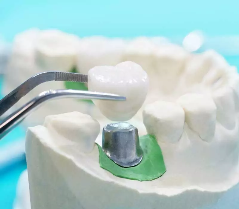 Home 13 Dental Crowns Restorative Dentistry Dentist in Weston Fl