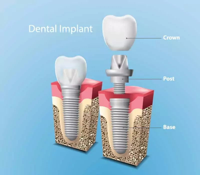 Home 12 Dental Implants Restorative Dentistry Dentist in Weston Fl